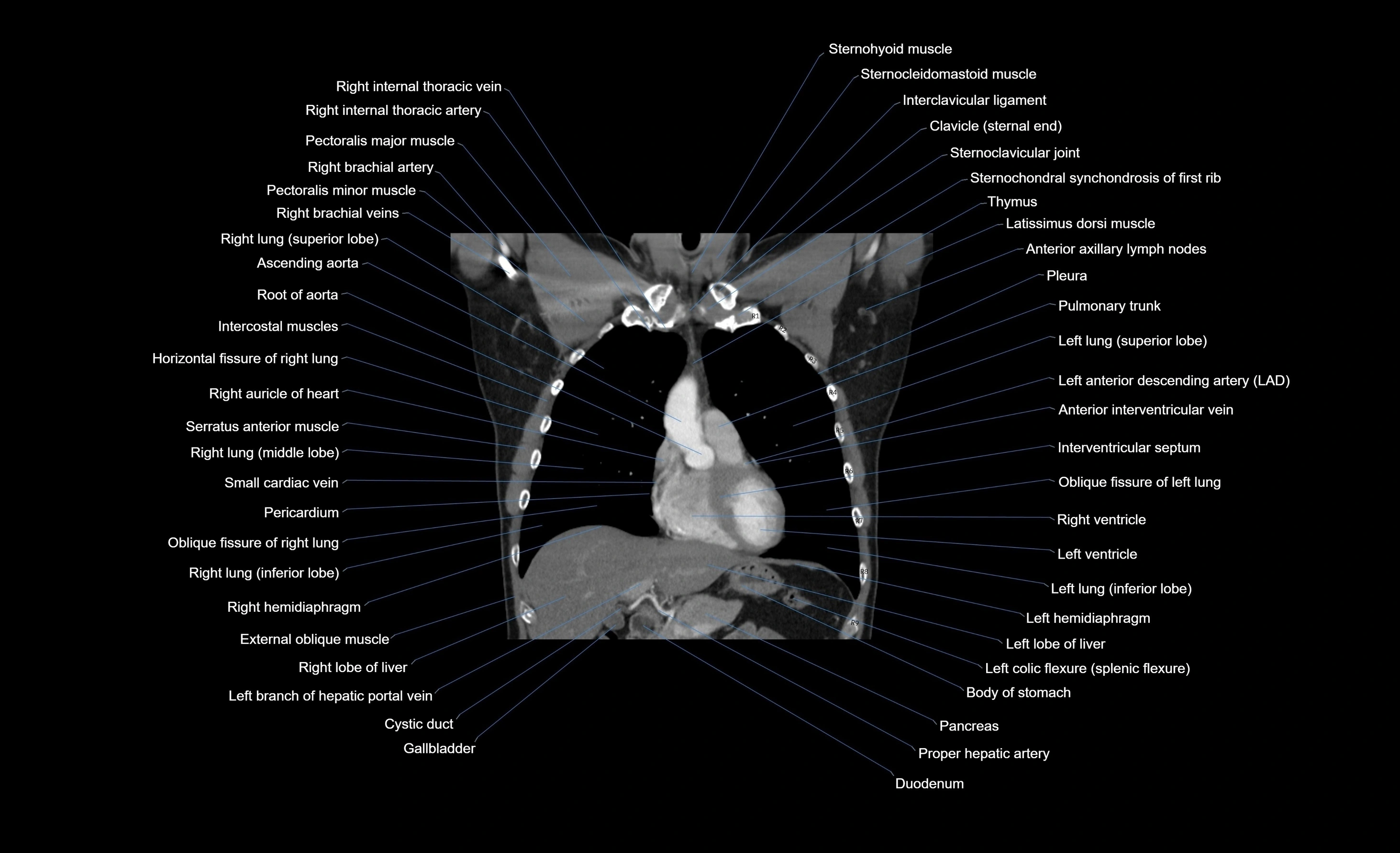 CT chest (thorax) labelled coronal cross sectional anatomy radiology image-00079.webp